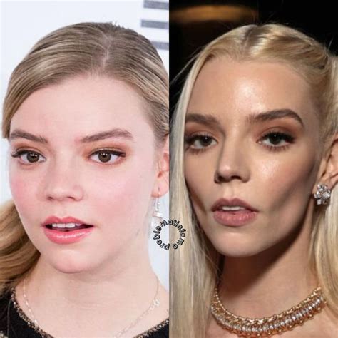 anya taylor-joy teeth|Anya Taylor Joy teeth then and now: before and after surgery。